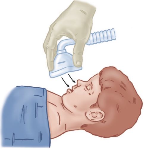 Insuflasi obat anestesi inhalasi di wajah pasien anak selama induksi